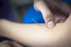 Photo of acup being done on a client/Willow Wellness Physiotherapy Acupuncture Massage Therapy Clinic | Langley BC