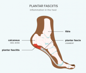 Plantar Fasciitis/Willow Wellness Physiotherapy Acupuncture Massage Therapy Clinic | Langley BC